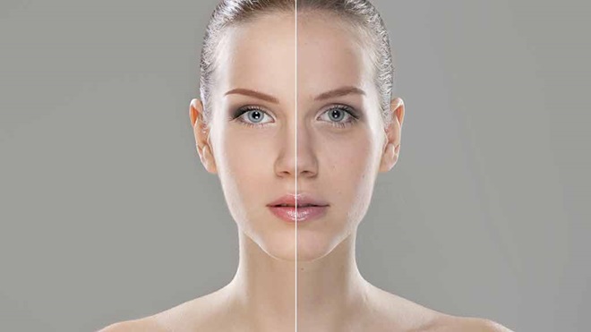 woman pre and post treatment